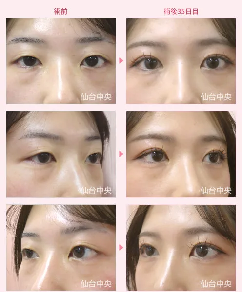 今田美桜の整形疑惑、結論は?